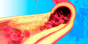 Atherosclerosis. Computer artwork of a narrowed artery, due to a cholesterol plaque.